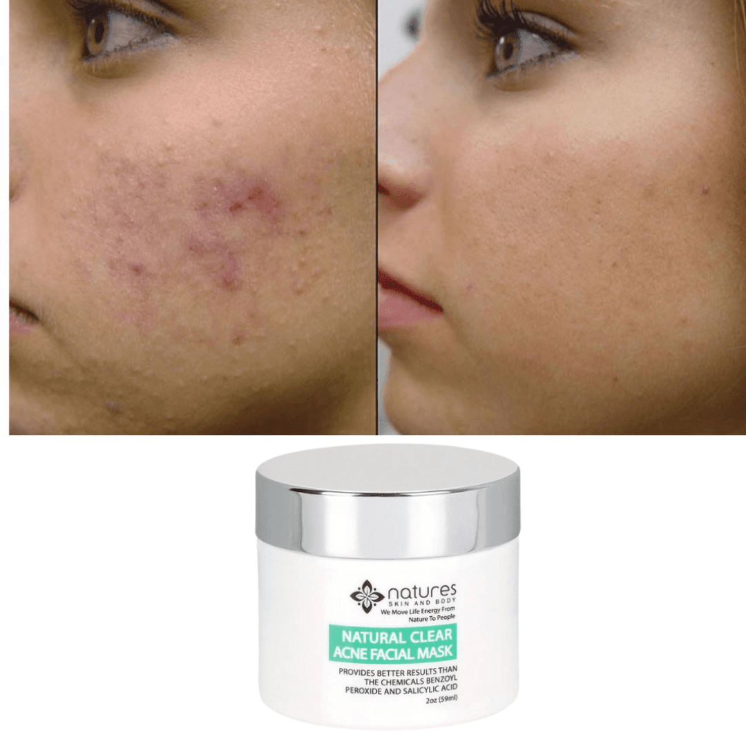 Natural Clear-Acne Treatment Mask-Provides Better Results Than The Chemicals Benzoyl Peroxide And Salicylic Acid.