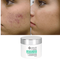 Thumbnail for Natural Clear-Acne Treatment Mask-Provides Better Results Than The Chemicals Benzoyl Peroxide And Salicylic Acid.