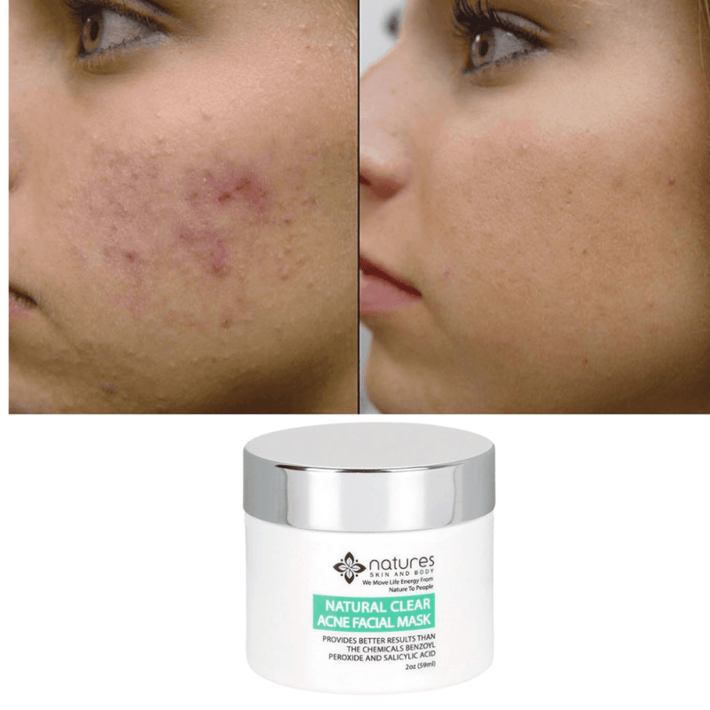 Natural Clear-Acne Treatment Mask-Provides Better Results Than The Chemicals Benzoyl Peroxide And Salicylic Acid.