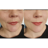 Biozyme Enzyme Peel-Chemical Peel Results Without The Chemicals.