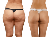 Thumbnail for 2 Step System to Remove Cellulite