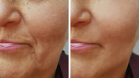 Thumbnail for Biozyme Enzyme Peel-Chemical Peel Results Without The Chemicals.