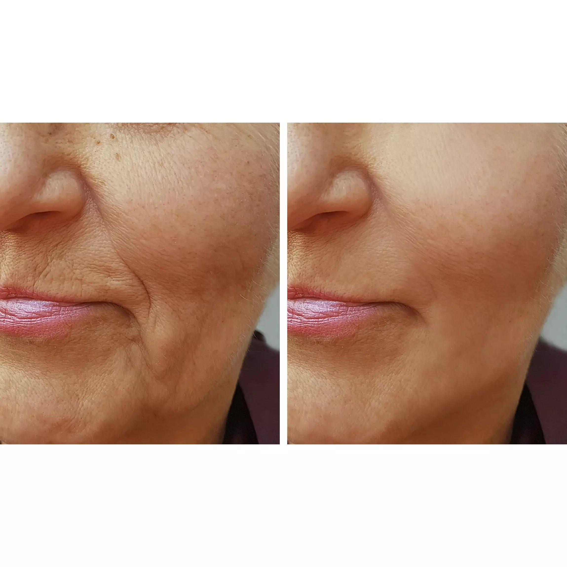 Natural Fusion Face And Neck Lifting Cream-Instantly Lifts And Firms With Results Improving Over Time. 100% Non-Toxic. All-Natural Ingredients.